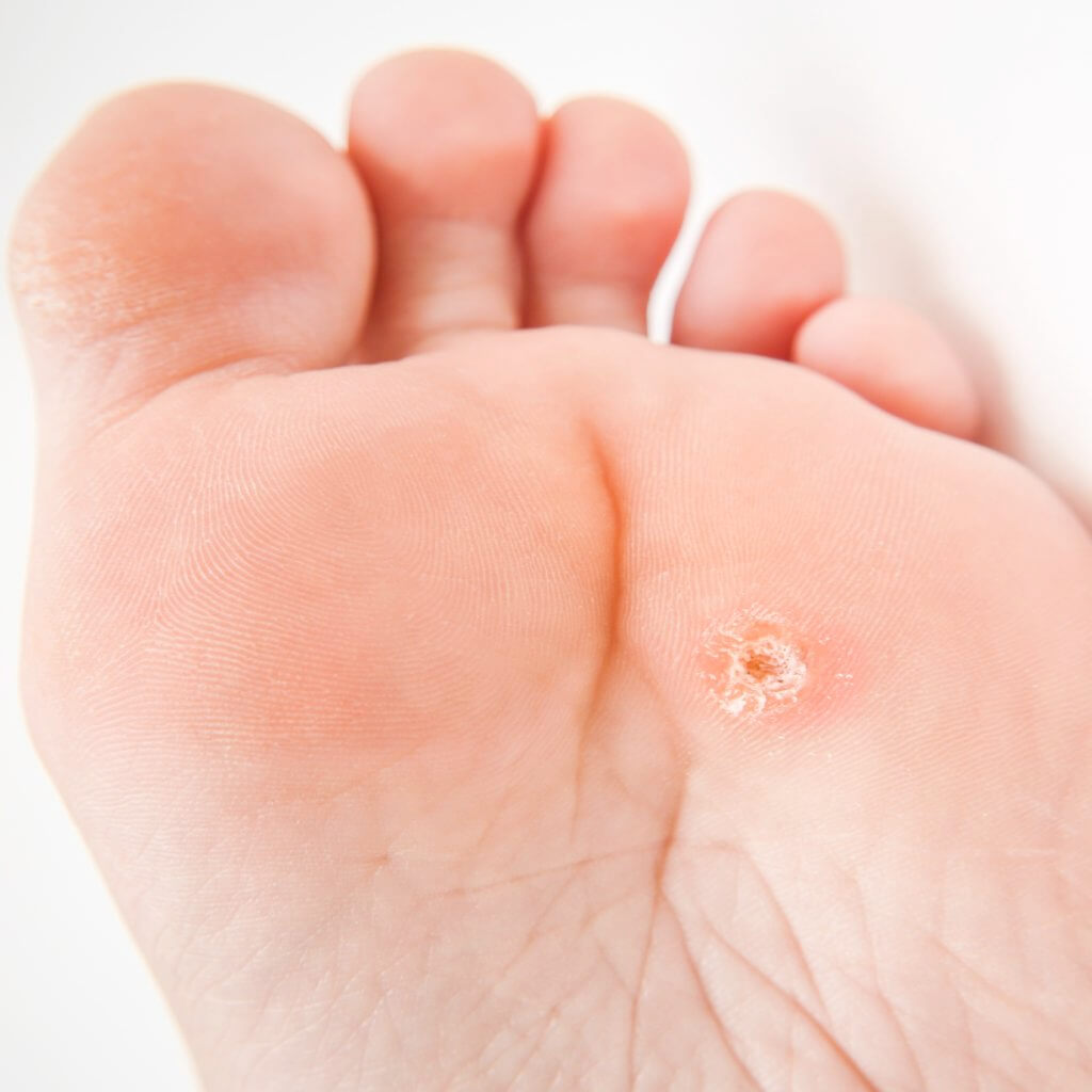 برداشت میخچه